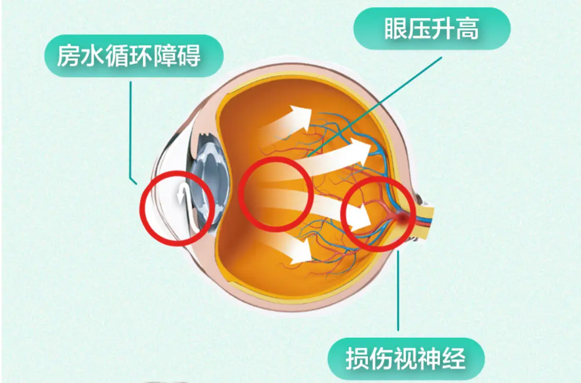 青光眼可以打游戏吗_打手机游戏会得青光眼吗_青光眼能玩游戏吗